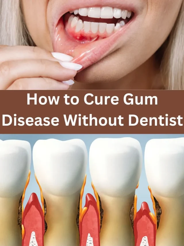 How to Cure Gum Disease Without Dentist